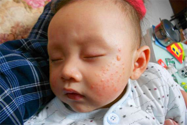 春季婴幼儿湿疹高发 六成靠润肤四成才需药