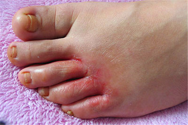 手脚脱皮分四种 8招对症下药缓解脱皮皲裂