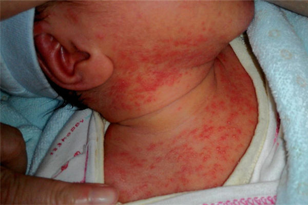 春季幼儿疹子高发 专家支招父母如何看疹识病