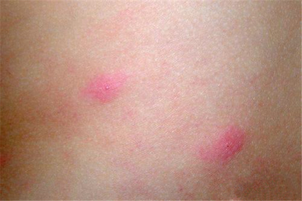 胆碱能性荨麻疹是什么？