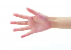 手脱皮是什么原因 手脱皮怎么治疗