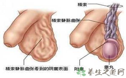 患了精索静脉曲张怎么办