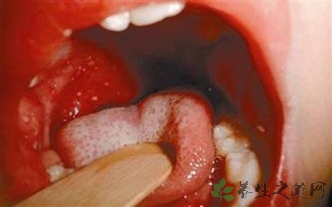 喉咙疱疹是怎么回事