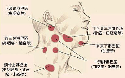 淋巴癌能治好吗