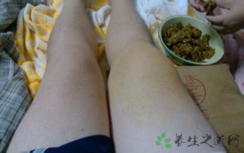 滑膜炎最佳治疗方法