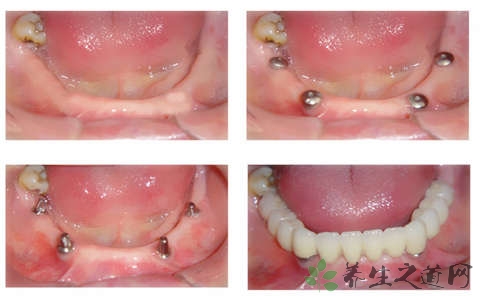 种植牙的危害