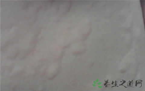 荨麻疹能治好吗