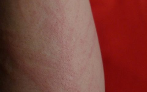 皮炎湿疹反复发作是什么原因