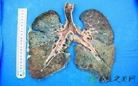肺矽病的症状