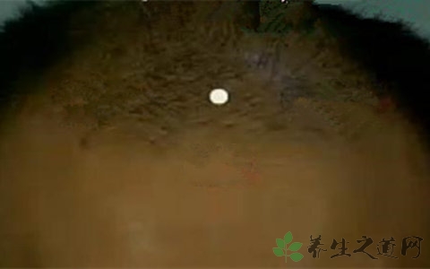 头额前中线是什么穴位