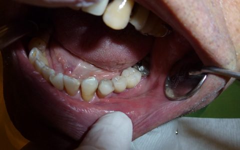 牙髓炎根管治疗费用
