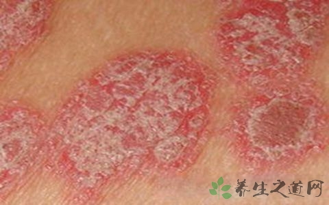 血热的症状