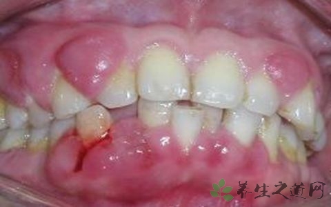 3,溃疡:就牙龈癌早期症状有哪些的问题,其实凡有原因不明的牙龈肿块