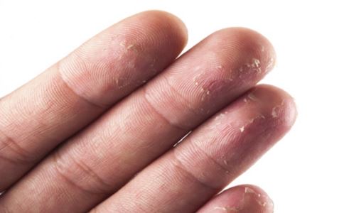 手脱皮是什么原因 手脱皮的原因有哪些 手脱皮怎么办