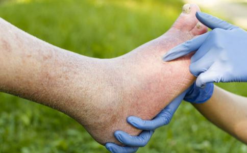 老人脚肿是什么原因 老人脚肿怎么消肿 脚肿怎么消下去
