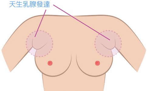 副乳是什么 副乳怎么消除 副乳图片