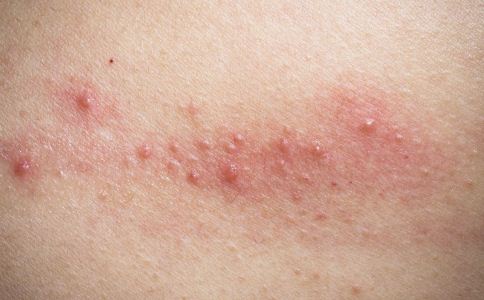 秋季如何预防湿疹 秋季湿疹怎么办 秋季湿疹如何治疗