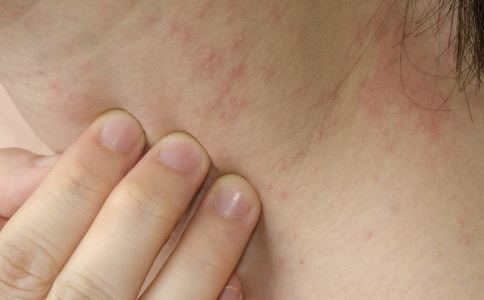 秋季如何预防湿疹 秋季湿疹怎么办 秋季湿疹如何治疗