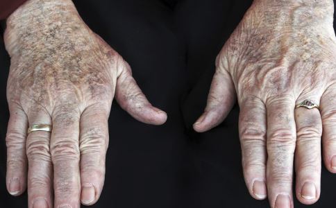 老年斑是什么 如何祛除老年斑 祛除老年斑最快的方法