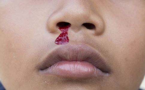 流鼻血怎么办 流鼻血如何快速止血 鼻子出血怎么止血