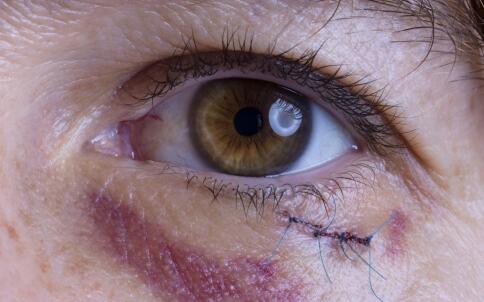 红眼病怎么传染 红眼病传染途径 红眼病传染