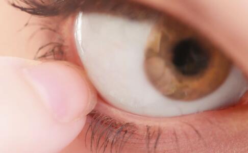 沙眼的症状 沙眼有什么症状 沙眼症状有哪些