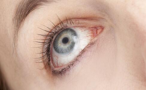 红眼病 假睫毛 红眼病的病因 红眼病症状
