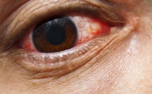 什么是红眼病 怎么治疗红眼病 如何治疗红眼病