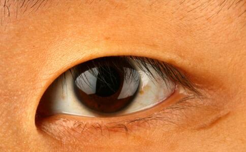 青光眼恶化不能用哪些药 青光眼恶化要注意什么 容易导致青光眼恶化的药有哪些